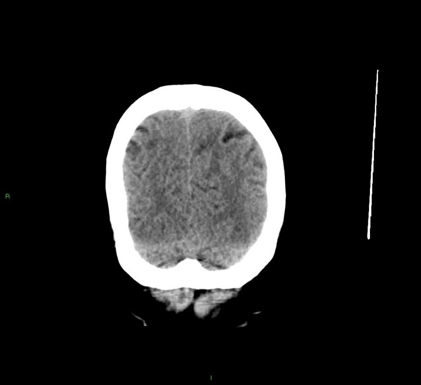 Cerebral amyloid angiopathy-associated lobar intracerebral hemorrhage (Radiopaedia 58529-65681 Coronal non-contrast 12).jpg