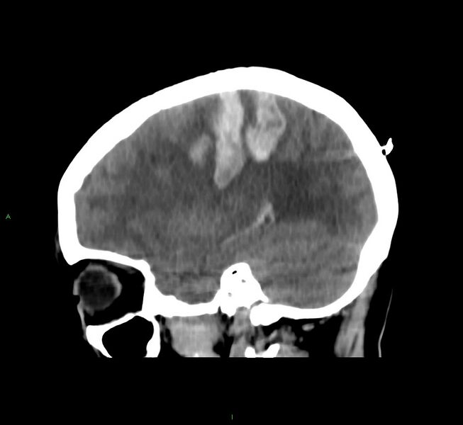 File:Cerebral amyloid angiopathy-associated lobar intracerebral hemorrhage (Radiopaedia 58566-65730 C 16).jpg