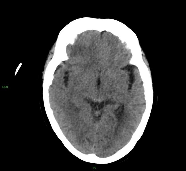 File:Cerebral amyloid angiopathy-associated lobar intracerebral hemorrhage (Radiopaedia 58569-65734 Axial non-contrast 36).jpg