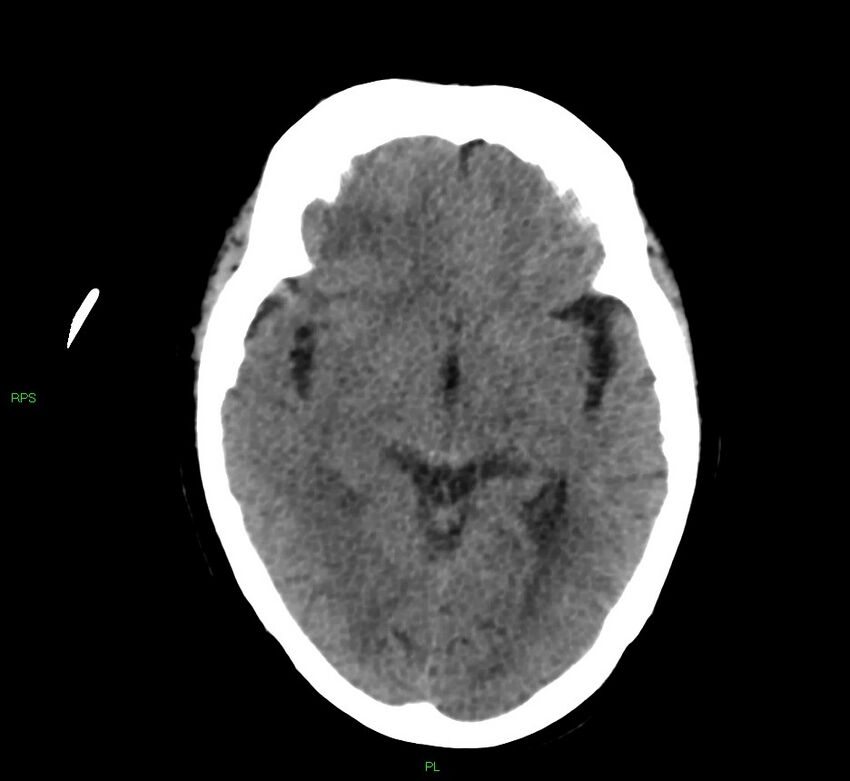 Cerebral amyloid angiopathy-associated lobar intracerebral hemorrhage (Radiopaedia 58569-65734 Axial non-contrast 36).jpg