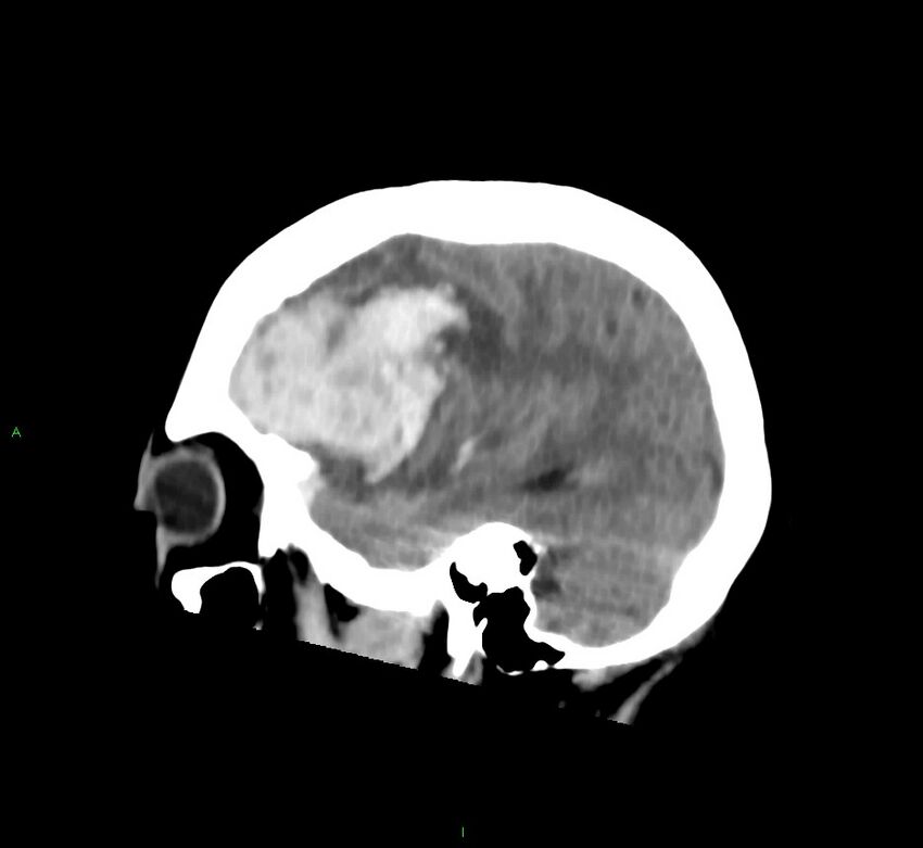 Cerebral amyloid angiopathy-associated lobar intracerebral hemorrhage (Radiopaedia 58752-65973 C 40).jpg