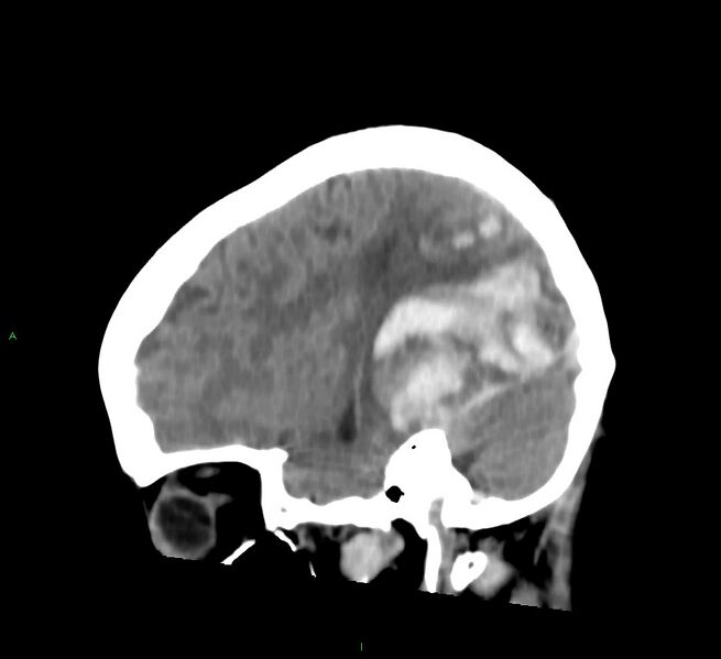File:Cerebral amyloid angiopathy-associated lobar intracerebral hemorrhage (Radiopaedia 58754-65975 C 35).jpg