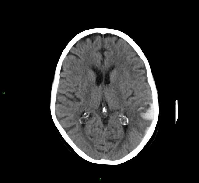File:Cerebral amyloid angiopathy-associated lobar intracerebral hemorrhage (Radiopaedia 58757-65978 Axial non-contrast 26).jpg