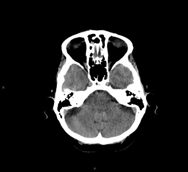 File:Cerebral amyloid angiopathy-associated lobar intracerebral hemorrhage (Radiopaedia 58757-65978 Axial non-contrast 39).jpg
