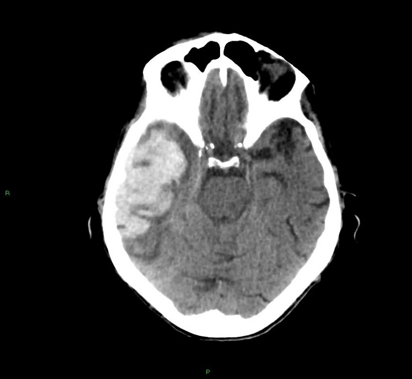 Cerebral amyloid angiopathy-associated lobar intracerebral hemorrhage (Radiopaedia 58758-65980 Axial non-contrast 33).jpg