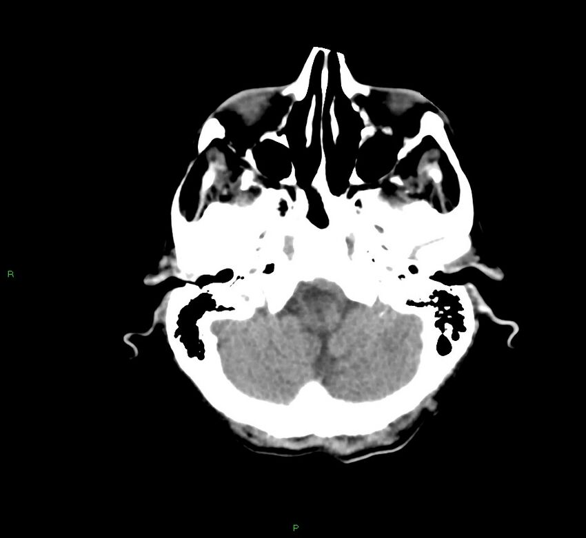 Cerebral amyloid angiopathy-associated lobar intracerebral hemorrhage (Radiopaedia 58758-65980 Axial non-contrast 42).jpg