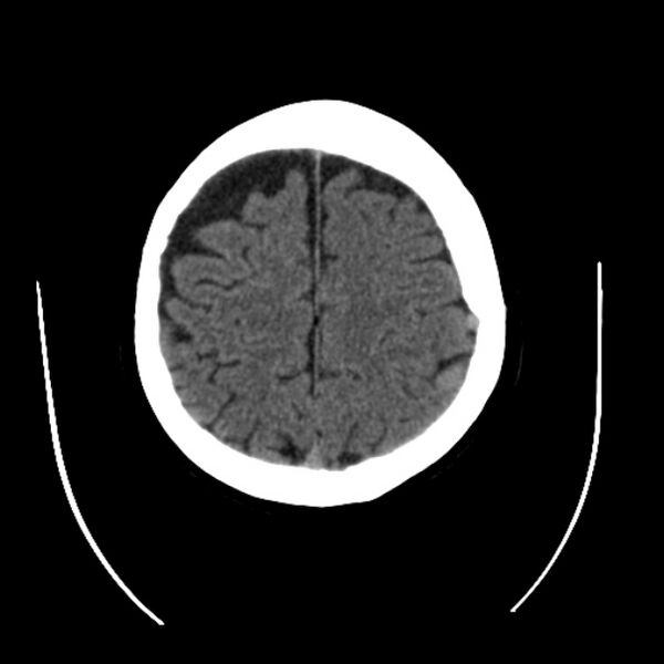 File:Cerebral arteriovenous malformation (Radiopaedia 43729-47189 Axial non-contrast 34).jpg