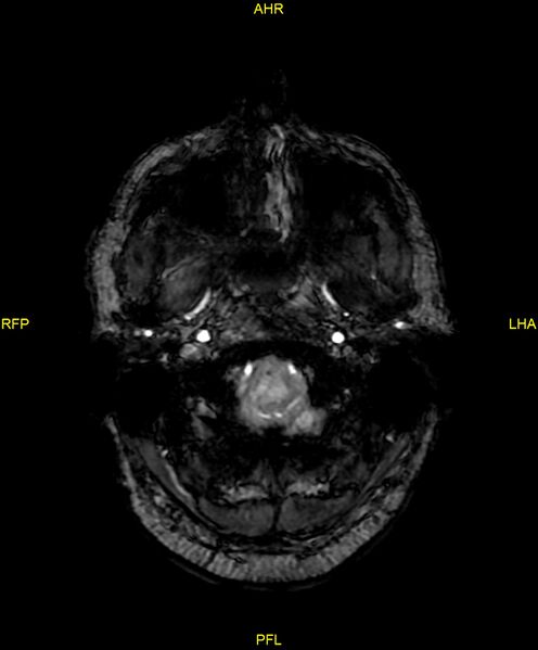File:Cerebral autosomal dominant arteriopathy with subcortical infarcts and leukoencephalopathy (CADASIL) (Radiopaedia 86108-102054 Axial SWI 12).jpg