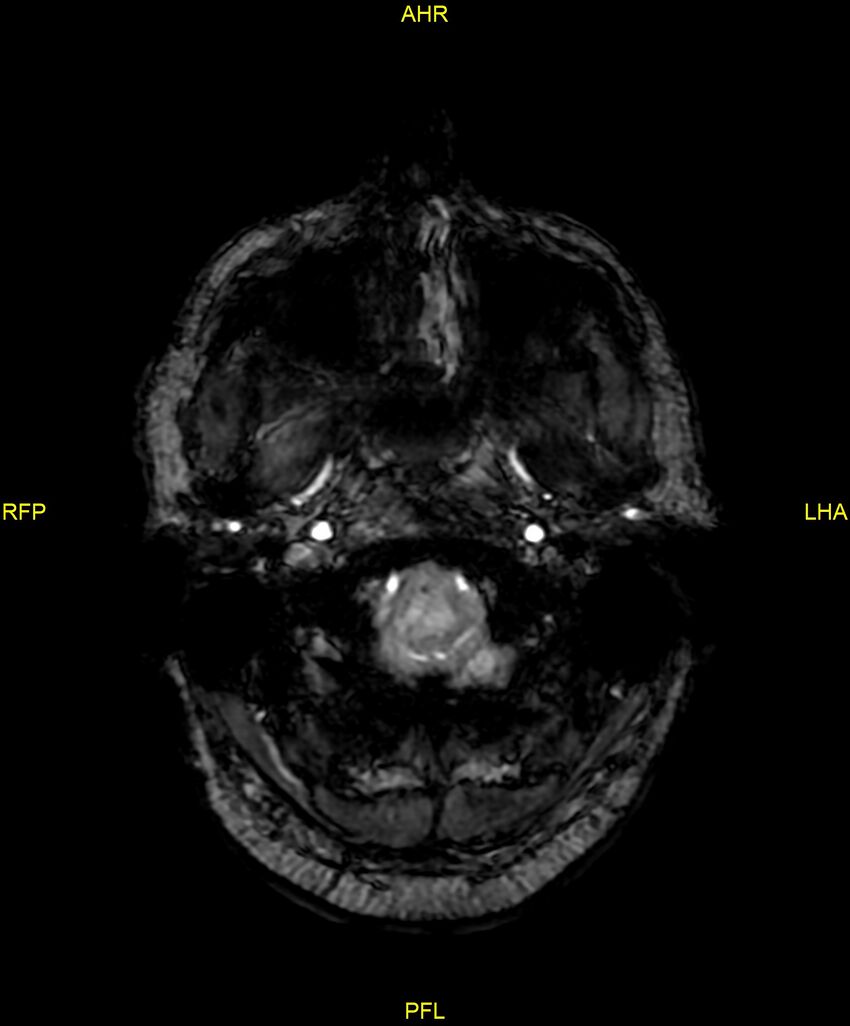 Cerebral autosomal dominant arteriopathy with subcortical infarcts and leukoencephalopathy (CADASIL) (Radiopaedia 86108-102054 Axial SWI 12).jpg