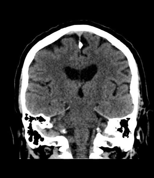 File:Cerebral dural venous sinus thrombosis (Radiopaedia 86514-102575 Coronal non-contrast 28).jpg