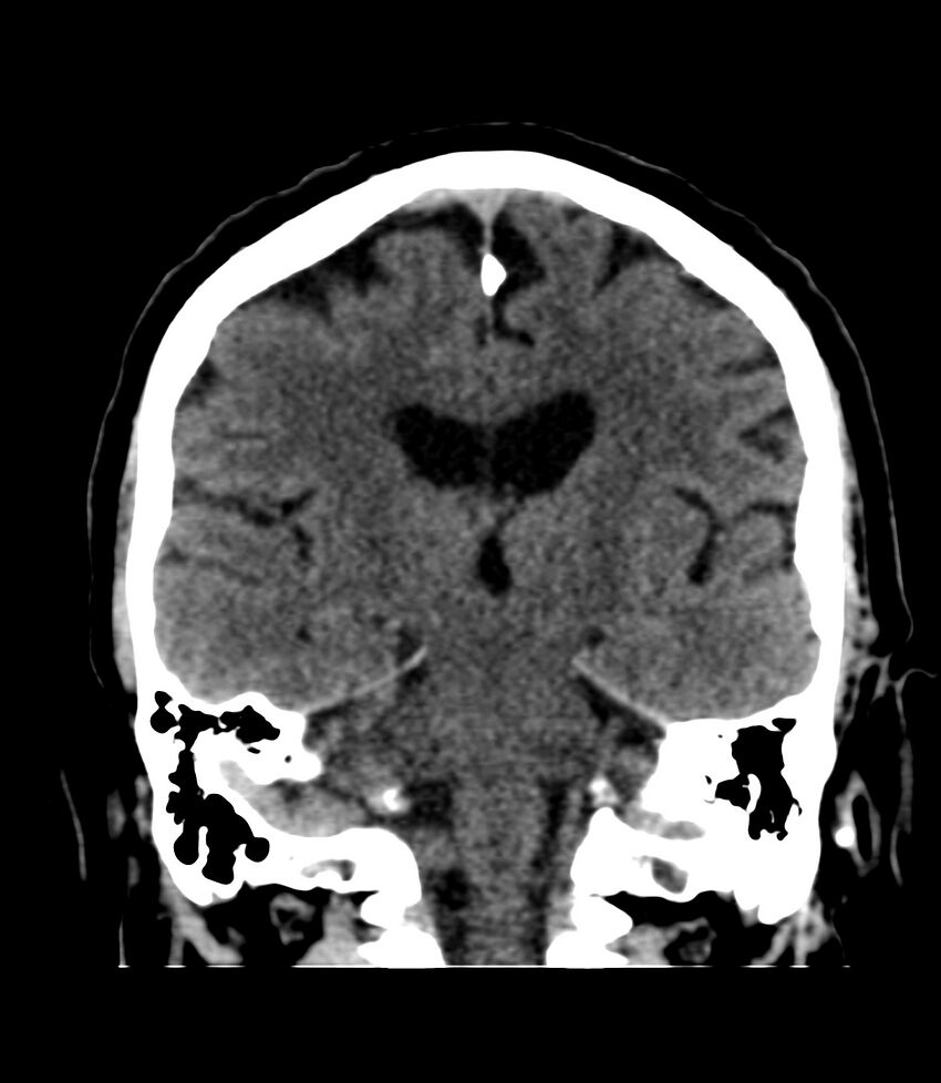 Cerebral dural venous sinus thrombosis (Radiopaedia 86514-102575 Coronal non-contrast 28).jpg