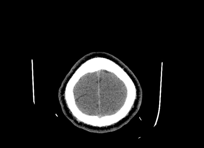 File:Cerebral edema (Radiopaedia 82519-96661 Axial non-contrast 7).jpg