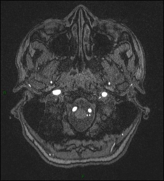 File:Cerebral fat embolism (Radiopaedia 35022-36525 Axial TOF 12).jpg