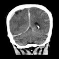 Cerebral hemorrhagic contusions (Radiopaedia 23145-23188 Coronal non-contrast 32).jpg