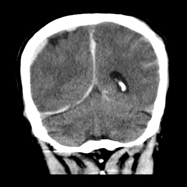 File:Cerebral hemorrhagic contusions (Radiopaedia 23145-23188 Coronal non-contrast 32).jpg