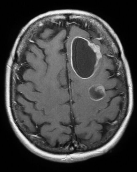 File:Cerebral metastases - small cell lung cancer (Radiopaedia 3972-6521 F 1).jpg