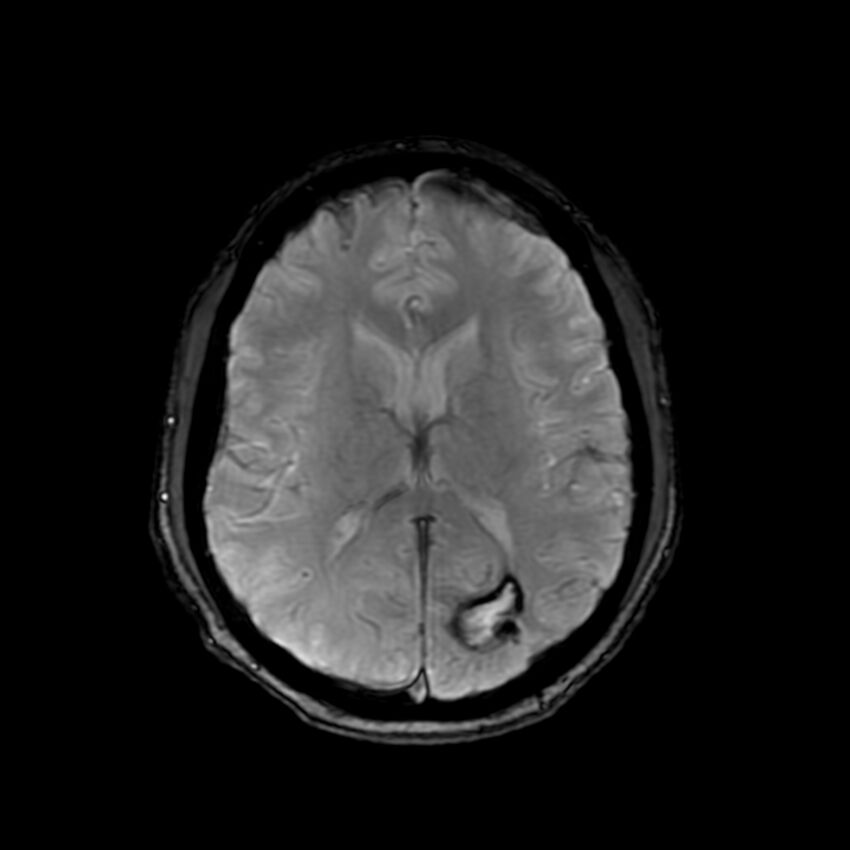 Cerebral paragonimiasis (Radiopaedia 73473-84238 Axial SWI 40).jpg
