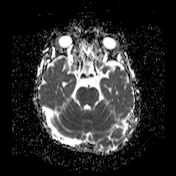 File:Cerebral tuberculoma (Radiopaedia 41152-43932 Axial ADC 7).jpg