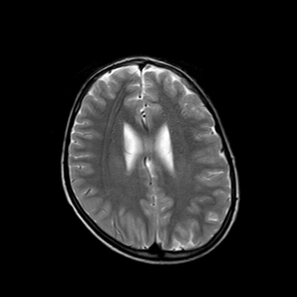 File:Cerebral tuberculoma (Radiopaedia 41152-43932 Axial T2 15).jpg