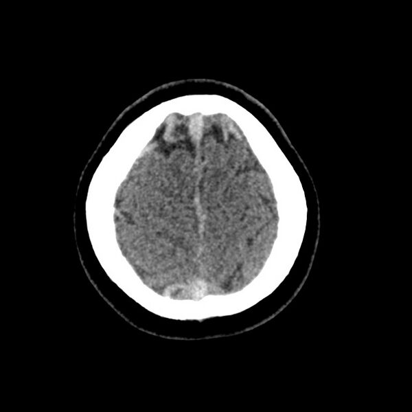 File:Cerebral venous sinus thrombosis (Radiopaedia 59224-66551 Axial non-contrast 48).jpg