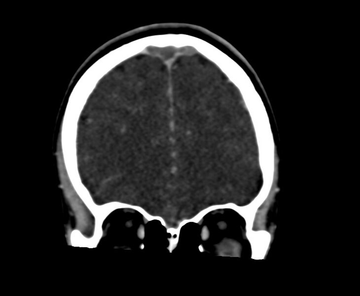 File:Cerebral venous sinus thrombosis (Radiopaedia 59224-66646 Coronal C+ delayed 16).jpg