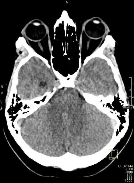 File:Cerebral venous sinus thrombosis (Radiopaedia 91329-108965 Axial non-contrast 15).jpg
