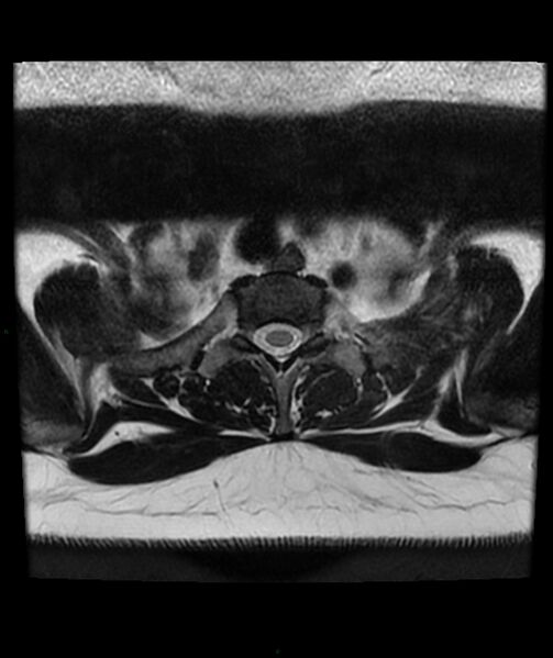 File:Cervical disc prolapse (Radiopaedia 80258-93598 Axial T2 92).jpg