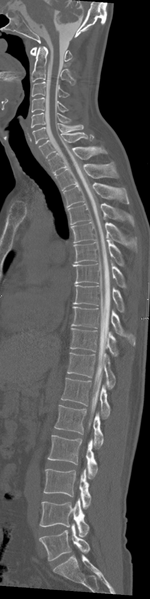 File:Cervical dural CSF leak on MRI and CT treated by blood patch (Radiopaedia 49748-54996 A 7).png