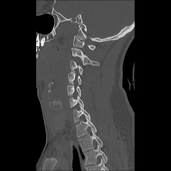 File:Cervical facet fracture and anterior discoligamentous injury (Radiopaedia 32139-33083 Sagittal bone window 12).jpg
