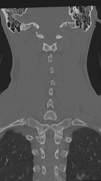File:Cervical intercalary bone (Radiopaedia 35211-36748 Coronal bone window 53).png