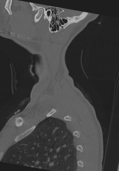 File:Cervical intercalary bone (Radiopaedia 35211-36748 Sagittal bone window 79).png