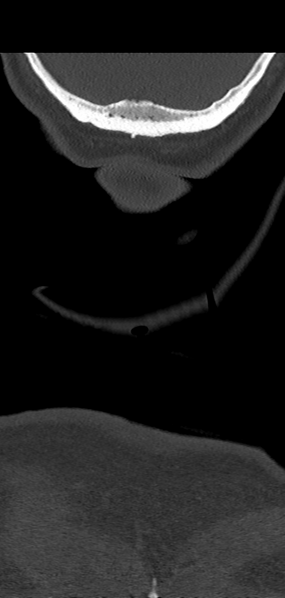 File:Cervical spine fracture - chalk stick (Radiopaedia 39116-41323 Coronal bone window 67).png