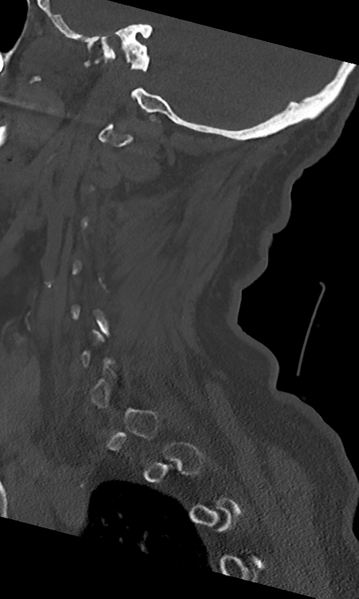 File:Cervical spine fracture - chalk stick (Radiopaedia 39116-41323 Sagittal bone window 45).png