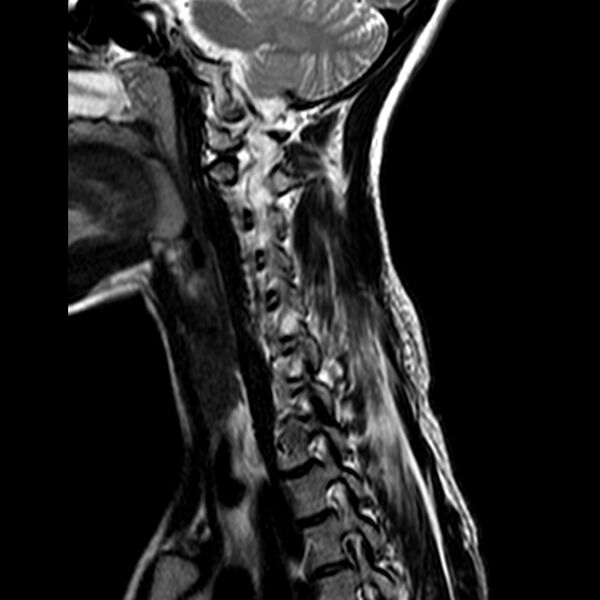 File:Cervical spine posterior ligamentous complex rupture (Radiopaedia 63486-72103 Sagittal T2 10).jpg
