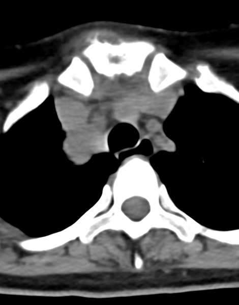 File:Cervical tuberculous spondylitis (Radiopaedia 39149-41365 Axial non-contrast 55).png