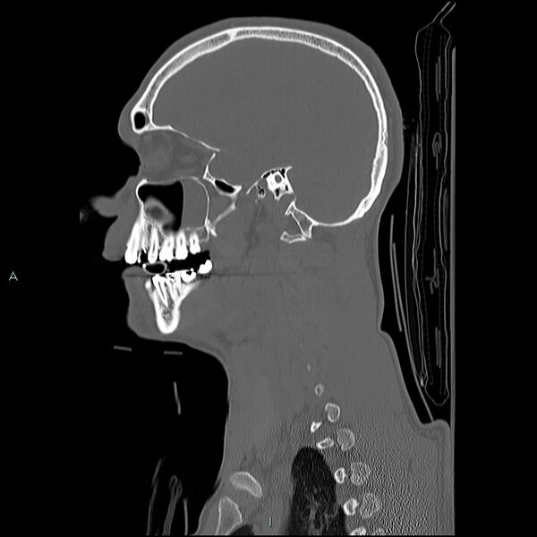File:Cervical vertebral burst fracture (Radiopaedia 37420-39258 Sagittal bone window 29).jpg