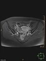 Cesarian scar endometriosis (Radiopaedia 68495-78066 Axial T1 C+ fat sat 10).jpg