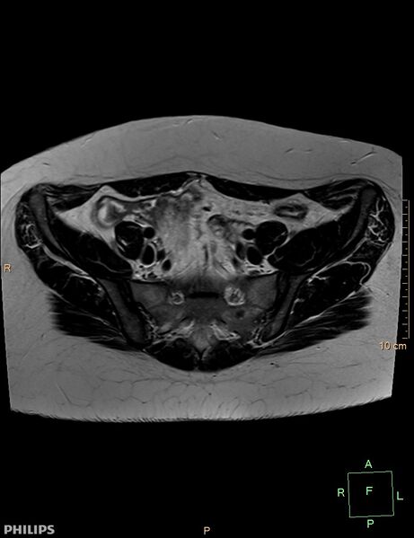 File:Cesarian scar endometriosis (Radiopaedia 68495-78066 Axial T2 4).jpg