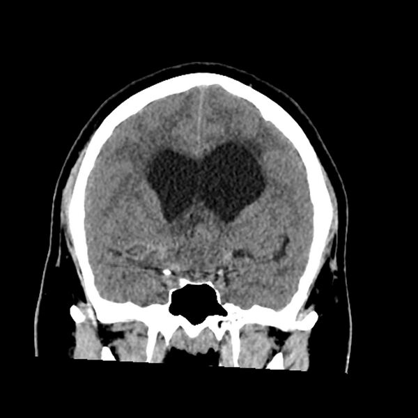 File:Chiasmatic-hypothalamic juvenile pilocytic astrocytoma (Radiopaedia 78533-91237 Coronal non-contrast 29).jpg