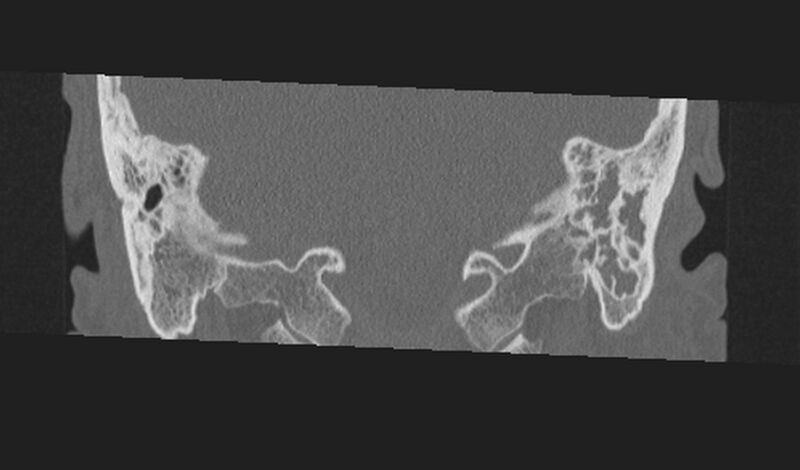 File:Cholesteatoma (Radiopaedia 10742-11203 Coronal bone window 26).jpg