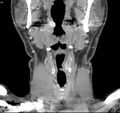 Chondrosarcoma - larynx (Radiopaedia 4588-6698 B 5).jpg