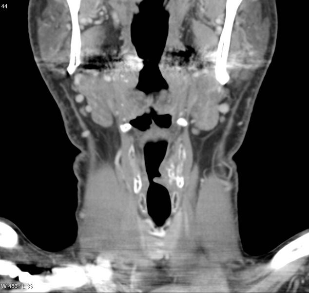 File:Chondrosarcoma - larynx (Radiopaedia 4588-6698 B 5).jpg