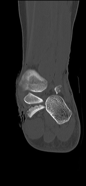 File:Chopart fracture (Radiopaedia 35347-36851 Coronal bone window 23).jpg