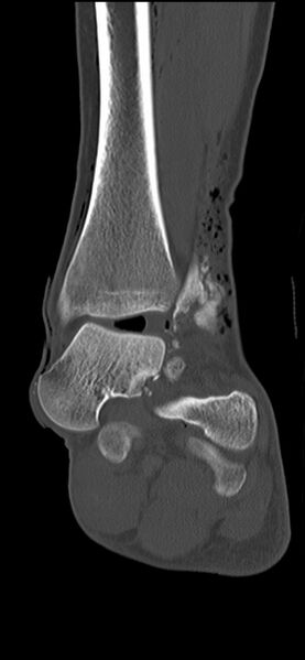 File:Chopart fracture (Radiopaedia 35347-36851 Coronal bone window 36).jpg