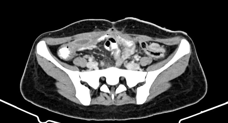 File:Choriocarcinoma liver metastases (Radiopaedia 74768-85766 A 153).jpg