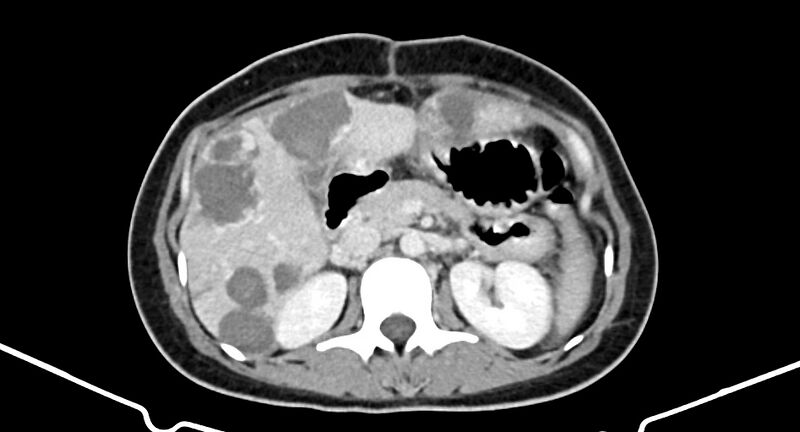File:Choriocarcinoma liver metastases (Radiopaedia 74768-85766 A 84).jpg