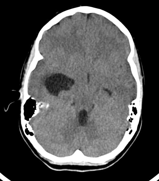 File:Choroid plexus carcinoma (Radiopaedia 91013-108552 Axial non-contrast 23).jpg