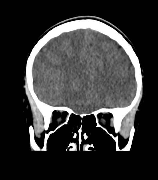 File:Choroid plexus carcinoma (Radiopaedia 91013-108552 Coronal non-contrast 24).jpg