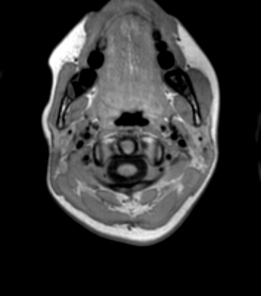File:Choroid plexus carcinoma (Radiopaedia 91013-108553 Axial T1 8).jpg