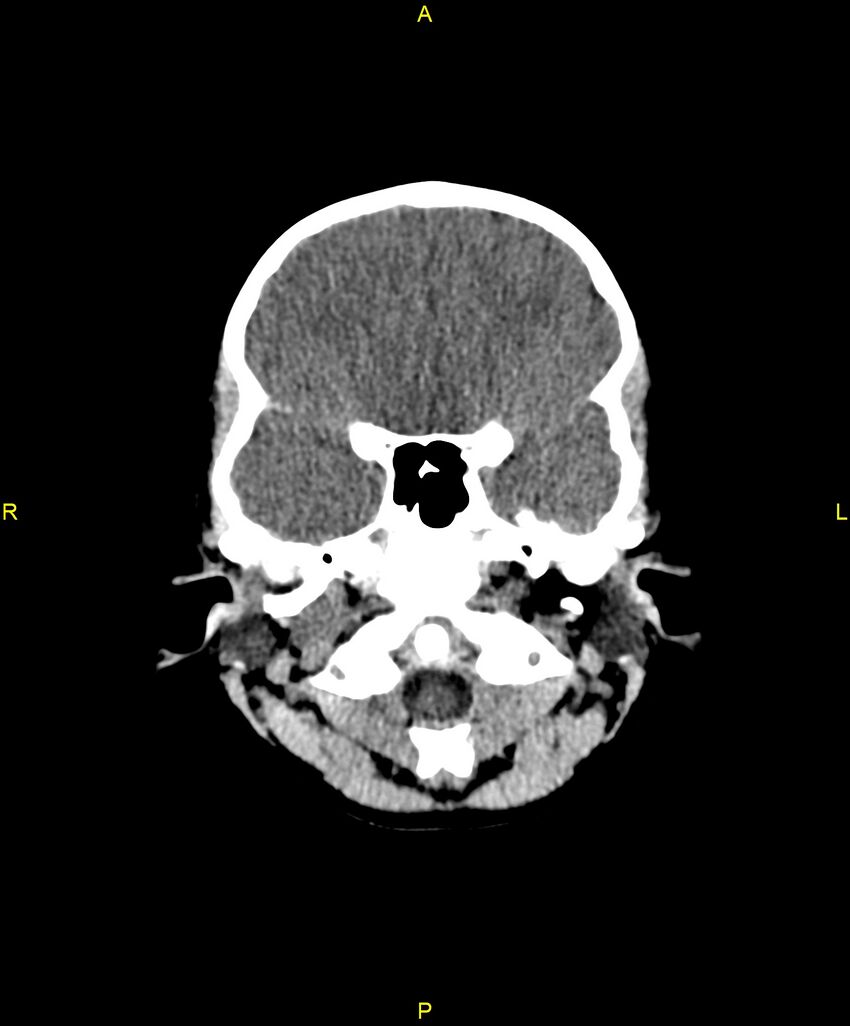 Choroidal fissure cyst (Radiopaedia 89481-106465 Axial non-contrast 28).jpg